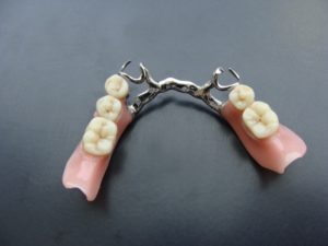 сьемное протезирование зубов