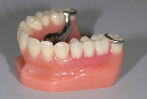 сьемное протезирование зубов