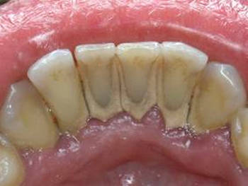 удаление твердого минерализированного зубного налета в стоматологической клинике Майстэрня Усмешки