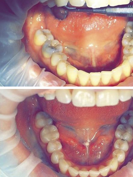 до и после лечения кариеса зубов в стоматологической клинике Майстэрня Усмешки
