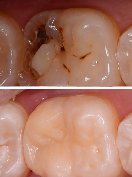 до и после лечения кариеса зубов в стоматологической клинике Майстэрня Усмешки