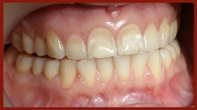 Некариозные дефекты зубов