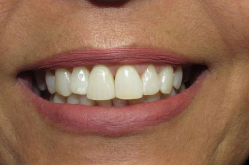 Одноэтапная имплантация зубов требования