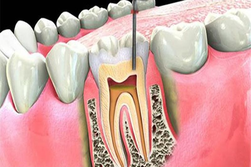 удалить зуб и удалить имплант зуба
