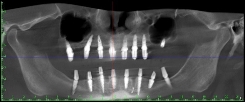 Атрофия костной ткани на обеих челюстях фото 10