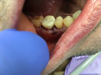 Удаление многокорневого зуба с инфекционным процессом на корнях